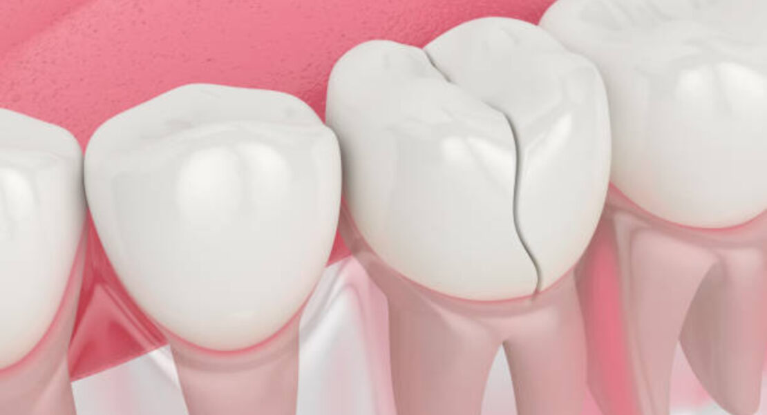 reparar dientes astillados