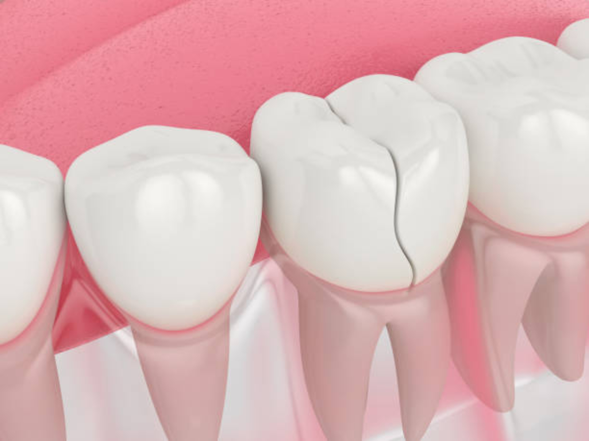 reparar dientes astillados